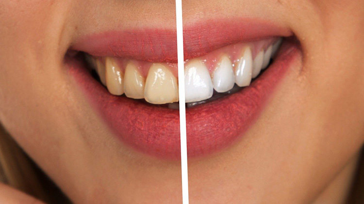 Cosmetic Dentistry Techniques Balog Blog Image Canvas 755x422px