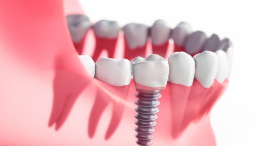 How Long Does A Dental Implant Procedure Take? - From Start to Finish