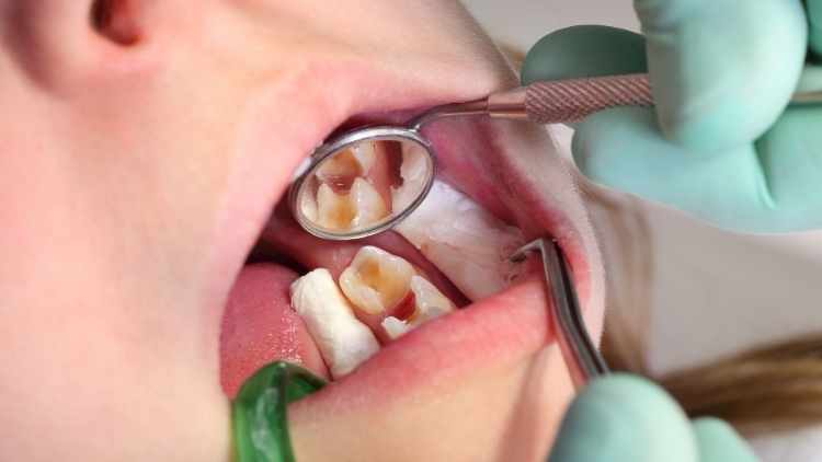 Top 5 Risk Factors For Cavities Gregory Balog DDS Monroe Michigan
