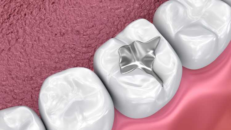 Understanding The Different Types Of Tooth Fillings A Comprehensive Guide
